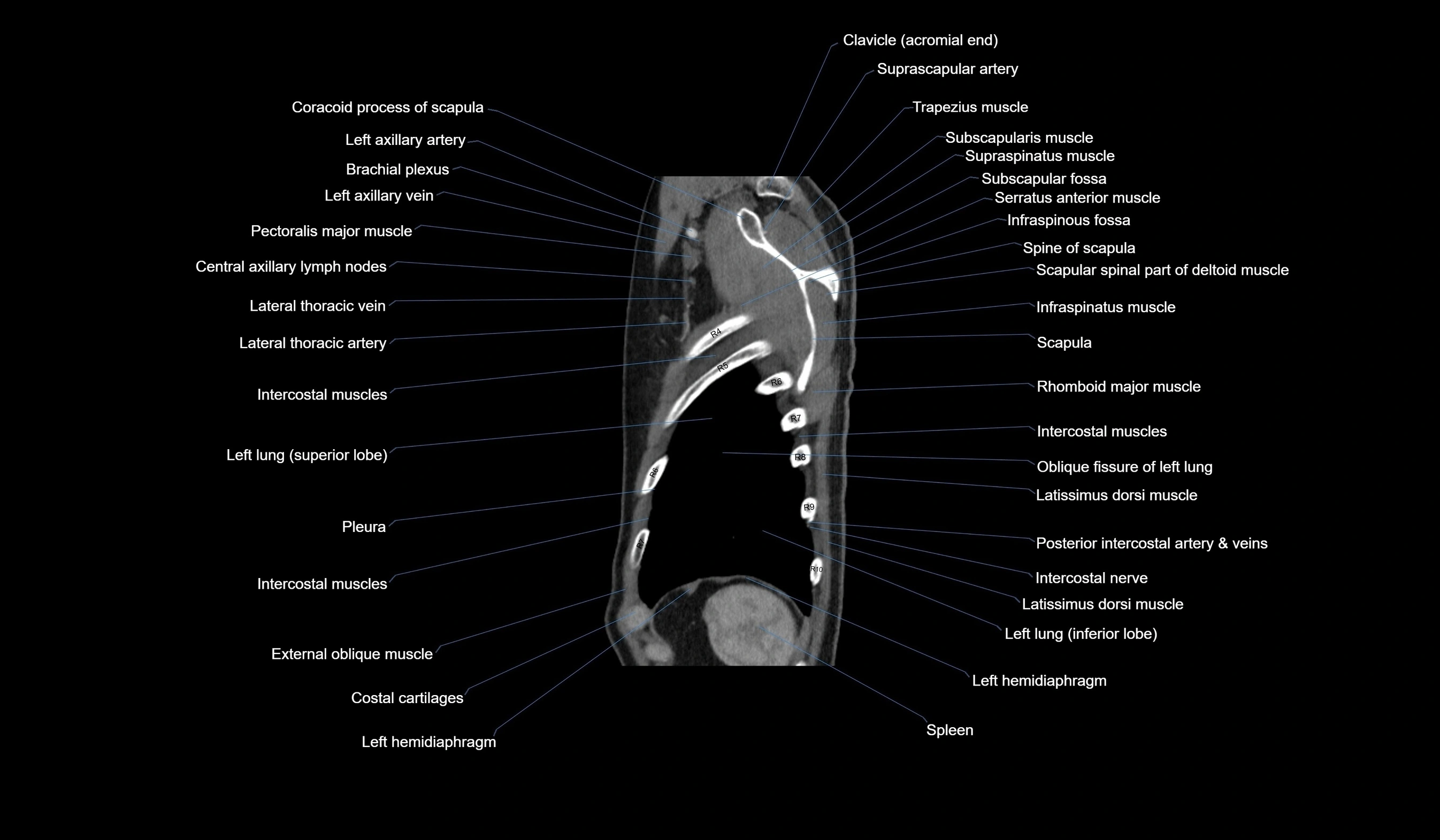 CT chest (thorax) labelled sagittal cross sectional anatomy radiology image-00125.webp